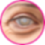 Cataract eye hospital in nashik